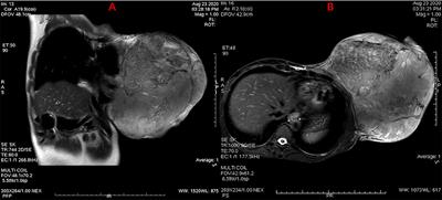 A Giant Borderline Phyllodes Tumor of Breast With Skin Ulceration Leading to Non-Insular Tumorigenic Hypoglycemia: A Case Report and Literature Review